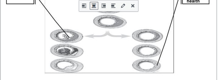 La maladie cardiaque artérielle est différente chez les femmes